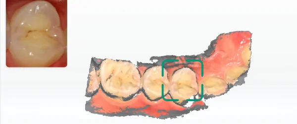 Aoralscan Lync (10).png