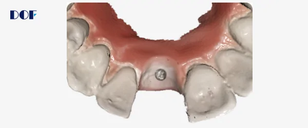 dof интраоральный сканер freedom i-2.png